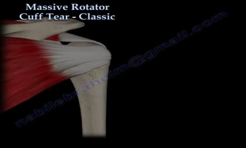 Massive Rotator Cuff Tear Classic Everything You Need To Know Dr. Nabil ...