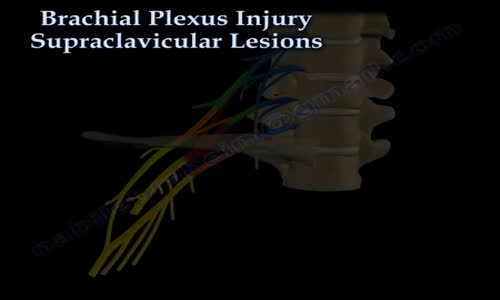 Brachial Plexus Injury, Supraclavicular Lesions Everything You Need To