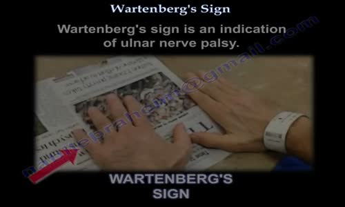 Wartenbergs Sign Everything You Need To Know Dr. Nabil Ebraheim