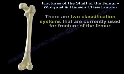 Fractures Of The Femur Shaft Winquist & Hansen Everything You Need To ...
