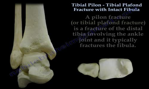 Tibial Pilon Fracture With Intact Fibula Everything You Need To Know Dr ...