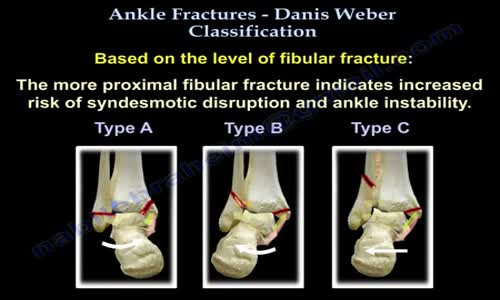 Ankle Fractures Danis Weber Classification Everything You Need To Know Ankle Fractures Danis Weber Classification Everything You Need To Know