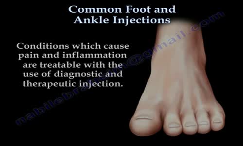 Common Foot And Ankle Injections Everything You Need To Know Dr. Nabil ...