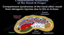 Compartment Syndrome Of The Hand & Finger  Everything You Need To Know  Dr. Nabil Ebraheim
