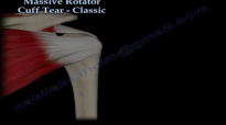 Massive Rotator Cuff Tear Classic  Everything You Need To Know  Dr. Nabil Ebraheim