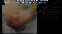 Clavicle fracture fixation  Everything You Need To Know  Dr. Nabil Ebraheim