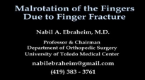 Finger Fractures Malrotation Of The Fingers  Everything You Need To Know  Dr. Nabil Ebraheim