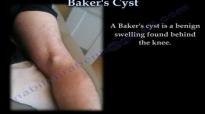 Bakers Cyst  Everything You Need To Know  Dr. Nabil Ebraheim
