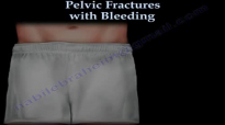 Pelvic Fractures With Bleeding  Everything You Need To Know  Dr. Nabil Ebraheim