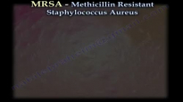 MRSA Methicillin Resistant Saphylococcus Aureus  Everything You Need To Know  Dr. Nabil Ebraheim