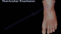 Navicular Fractures  Everything You Need To Know  Dr. Nabil Ebraheim