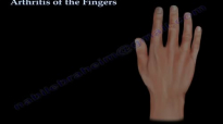 Arthritis Of The Fingers types and patterns  Everything You Need To Know  Dr. Nabil Ebraheim