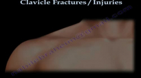 CLAVICLE FRACTURE treatment and repair  Everything You Need To Know  Dr. Nabil Ebraheim