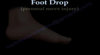 Foot Drop, Peroneal Nerve Injury  Everything You Need To Know  Dr. Nabil Ebraheim