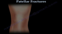Patellar Fractures  Everything You Need To Know  Dr. Nabil Ebraheim