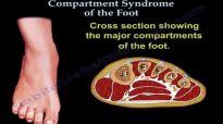 Foot Compartment Syndrome  Everything You Need to Know  Dr. Nabil Ebraheim
