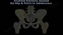 Avulsion Fractures Around The Hip In Adolescence  Everything You Need To Know  Dr. Nabil Ebraheim