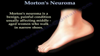 Mortons Neuroma  Everything You Need To Know  Dr. Nabil Ebraheim