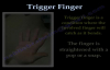 Trigger Finger and thumb  Everything You Need To Know  Dr. Nabil Ebraheim