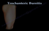 Trochanteric Bursitis , hip bursitis Everything You Need To Know  Dr. Nabil Ebraheim