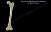 Reverse Oblique Fractures Of The Femur  Everything You Need To Know  Dr. Nabil Ebraheim