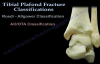 Pilon Fracture, Tibial Plafond Fracture  Everything You Need To Know  Dr. Nabil Ebraheim