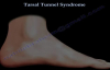 Tarsal Tunnel Syndrome  Everything You Need To Know  Dr. Nabil Ebraheim
