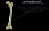 Ipsilateral Femoral Neck & Shaft Fractures  Everything You Need To Know  Dr. Nabil Ebraheim