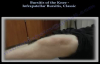 Knee Bursitis Infrapatellar Bursitis Classic  Everything You Need To Know  Dr. Nabil Ebraheim