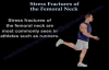 Stress Fractures Of The Femoral Neck  Everything You Need To Know  Dr. Nabil Ebraheim