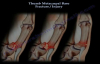 Thumb Metacarpal Base Fracture Injury  Everything You Need To Know  Dr. Nabil Ebraheim
