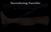 Necrotizing Fasciitis part I, flesh eating bacteria.Everything You Need To Know  Dr. Nabil Ebraheim