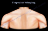 Trapezius Winging  Everything You Need To Know  Dr. Nabil Ebraheim