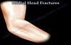 Radial Head Fracture Everything You Need To Know Dr. Nabil Ebraheim