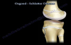 Osgood Schlatter Disease  Everything You Need To Know  Dr. Nabil Ebraheim
