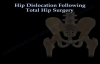 Hip Dislocation Following Total Hip replacement  Everything You Need To Know  Dr. Nabil Ebraheim