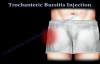 Trochanteric Bursitis Injection  Everything You Need To Know  Dr. Nabil Ebraheim