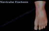 Navicular Fractures  Everything You Need To Know  Dr. Nabil Ebraheim