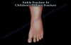 Ankle Fracture In Children Tillaux Fracture  Everything You Need To Know  Dr. Nabil Ebraheim
