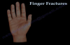 Finger and metacarpal Fractures  Everything You Need To Know  Dr. Nabil Ebraheim