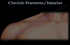 CLAVICLE FRACTURE treatment and repair  Everything You Need To Know  Dr. Nabil Ebraheim