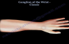 Ganglion Of The Wrist Classic  Everything You Need To Know  Dr. Nabil Ebraheim