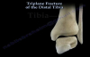 Triplane Fracture Of The Distal Tibia  Everything You Need To Know  Dr. Nabil Ebraheim