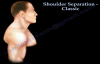 Shoulder Separation, Classic  Eveything You Need To Know  Dr. Nabil Ebraheim