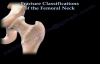 Femoral Neck Classifications  Everything You Need To Know  Dr. Nabil Ebraheim