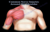 Shoulder Nerve injury ,Injuries  Everything You Need To Know  Dr. Nabil Ebraheim