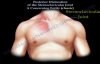 Posterior Dislocation Sternoclavicular ClassicEverything You Need To Know  Dr. Nabil Ebraheim
