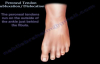 Peroneal Tendon Subluxation  Dislocation  Everything You Need To Know  Dr. Nabil Ebraheim