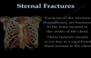 Sternal Fractures  Everything You Need To Know  Dr. Nabil Ebraheim