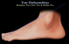 Toe Deformities Hammer, Claw & Mallet Toes  Everything You Need To Know  Dr. Nabil Ebraheim